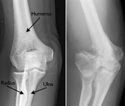 Dirsek üstü dövme